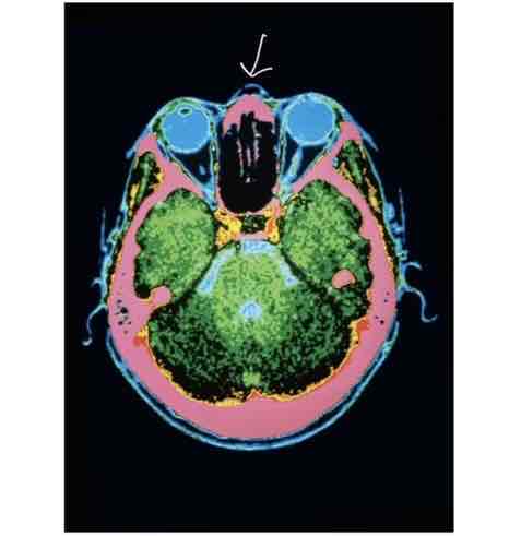 <ul><li><p>low-intensity x-rays and computer analysis</p></li><li><p>Increased sharpness</p></li></ul>