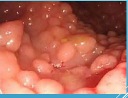 <p><strong>Familial Adenomatous Polyposis: FAP</strong></p><p>-__________ condition → 90% have a mutation of the ___ gene, inherited in an autosomal _________ fashion</p><p>-Early development of hundreds to thousands of colonic _____________ polyps </p><ul><li><p>Mean age of development is __y/o and _____ at 40y/o</p></li><li><p>CRC inevitable without proctocolectomy </p></li></ul><p>-Recommended complete proctocolectomy or _______ with ileoanal anastomosis before 20 y/o</p><p></p>