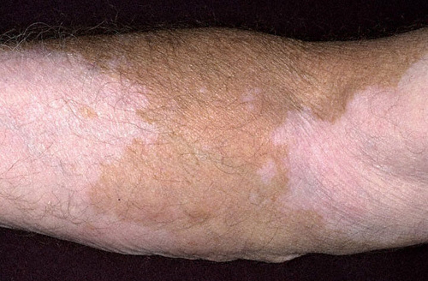 <p>flat, distinct discolored area</p><p>over 1cm</p><p>ex: vitiligo</p>