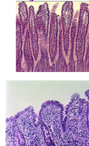 <p>infiltrative diseases of the <strong>gut wall</strong></p><ul><li><p>parasitic</p></li><li><p>inflammatory bowel disease</p></li><li><p>lymphagiectasia</p></li><li><p>GI lymphoma or other diffuse neoplasia</p></li><li><p>severe SIBO</p></li><li><p>dry feline infectious peritonitis</p></li><li><p>deep mycoses (endemic areas)</p></li></ul><p></p>