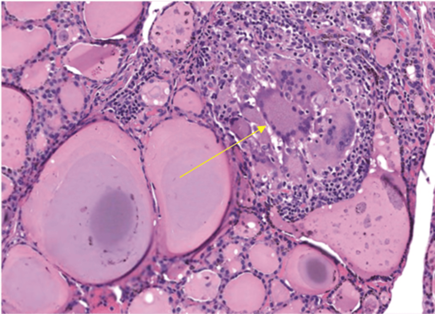 <p>Define Condition:</p><p>Self-limiting Granulomatous inflammation of the thyroid</p><p>-Hx: Transient Hyperthroidism --&gt; Euthyroid State --&gt; Hypothyroidism --&gt; Euthyroid State</p><p>-Path: URI shortly before (d/t viral infection or inflammation in response to infection)</p><p>-Sx/PE:</p><p>&gt; PAINFUL/TENDER Thyroid</p><p>-Dx:</p><p>&gt; Gross = Firm, enlarged (unilateral or bilateral) thyroid)</p><p>&gt; Micro =</p><p>&gt;&gt; Mixed inflammatory infiltrate (Partial destruction of follicles with a mononuclear lymphocytic infiltrate)</p><p>&gt;&gt; Follicle disruption --&gt; granulomatous inflammation (macrophages and mulitnucleated giant cells)</p>