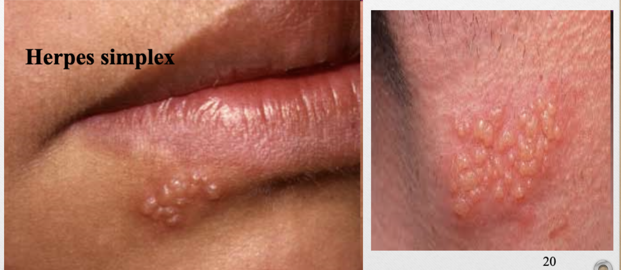 <p>ex. cold sore (herpes simplex)</p>