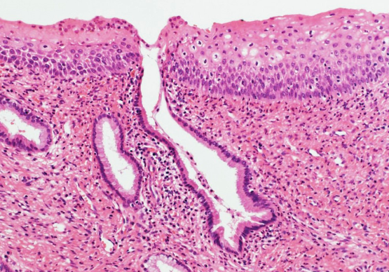 <ul><li><p><strong>Hyperplasia</strong>, loss of cilia</p></li><li><p>pseudostratified epithelium is replaced by <strong>squamous epithelium</strong></p></li></ul><p></p>