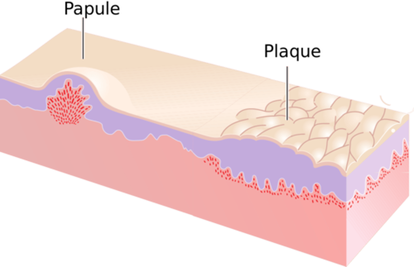 <p><b>Primary</b> <br><br>Less than 1.0 cm palpable elevated lesion <br><br>example: psoriasis</p>