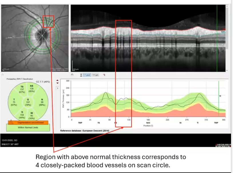 <p>effects of blood vessels </p>