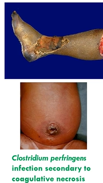 <ul><li><p>dark, discoloured, foul smelling tissue</p></li><li><p>result of ischaemia (coagulative necrosis) and infection of necrotic tissue with anaerobic bacteria, especially Clostridium spp</p></li></ul><p></p>