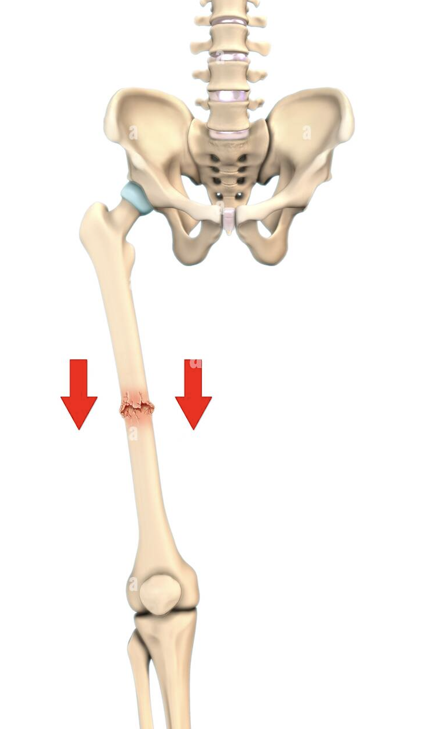 <p>Broken bone ends are forced into each other (commonly occurs when one attempts to break a fall with outstretched arms)</p>
