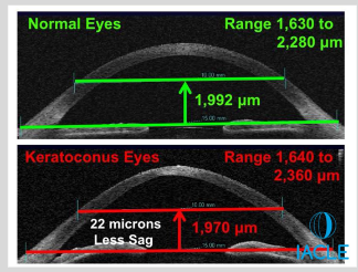 <ul><li><p>Topographers (e.g., Medmont) measure sag heights within 10.0 mm chord lengths</p></li><li><p>Avg sag height btwn 10.0 mm and 15.0 mm chord ≈ 2,000 μm</p><ul><li><p>Similar sag heights found in normal + keratoconic eyes</p></li><li><p>Sag from 10 to 15 mm chords is unaffected by rCorneal Apex</p></li></ul></li></ul><p></p>