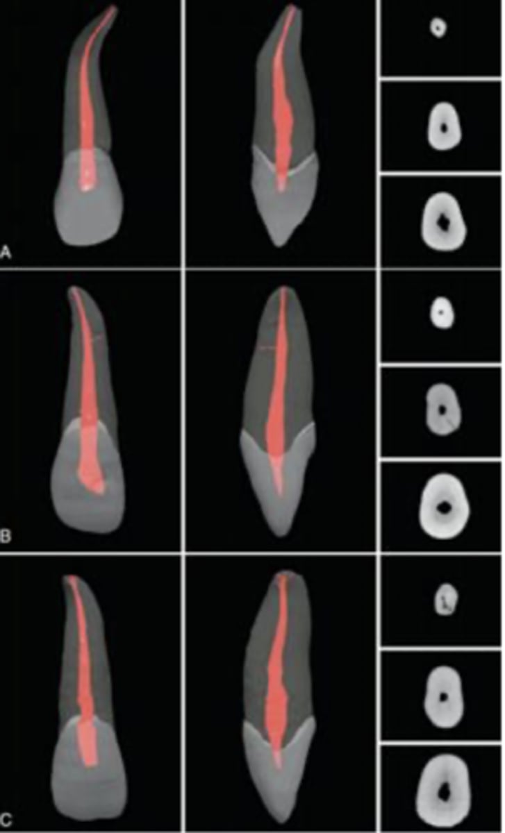 <p>ovoid (slightly flattened MD)</p>