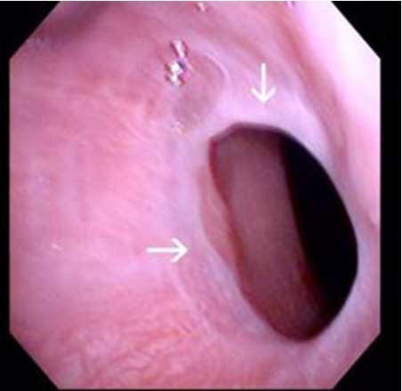 <p><strong>what condition?</strong></p><ul><li><p>thin fibrous protrusion of squamous epithelium in upper esophagus</p></li><li><p>can be asx or cause dysphagia +/- IDA</p></li><li><p>uncommon; increased in women</p></li><li><p>dx: EGD, BA xray studies</p></li><li><p>rx: endoscopy, esophageal dilation</p></li></ul><p></p>