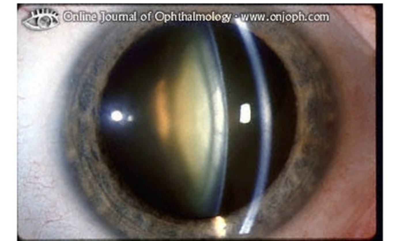 <p>Opaque nucleus, manifested as a yellow-brown hazy structure at the center of the lens on slit lamp examination</p>