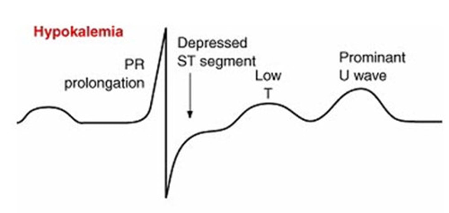 <p>dysrhythmias and muscle weakness, management - replace potassium, never IV push, monitor ECG, encourage potassium rich foods.</p>