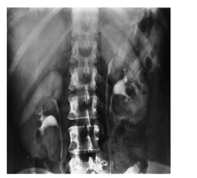 <p>A congenital anomaly where there are two ureters and renal pelvises associated with a single kidney, leading to potential drainage issues. </p>