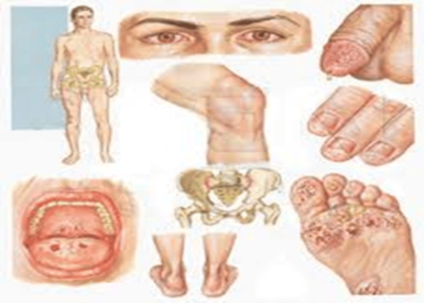 <p>Systemic Chlamydia and other</p><p>bacteria can cause this reactive</p><p>arthritis following the bacterial</p><p>infection; conjunctivitis, arthritis</p><p>(ankles and knees), urination issues</p>