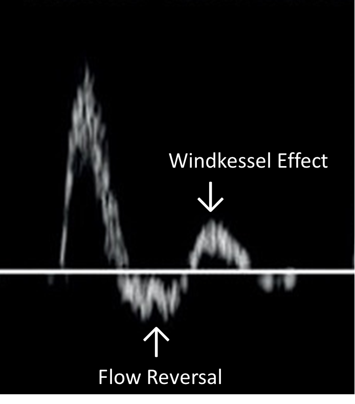 <p>Windkessel effect</p>