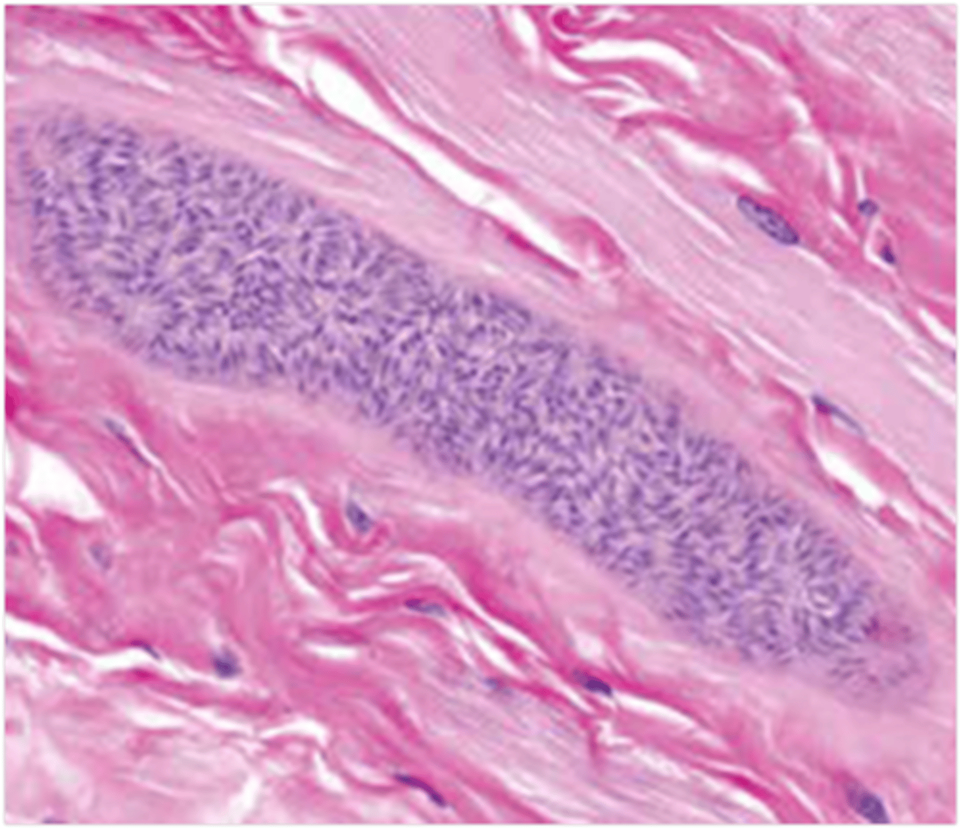 <p>This image shows histopathology of the skeletal eyelid muscle. What lesion is seen here?</p>