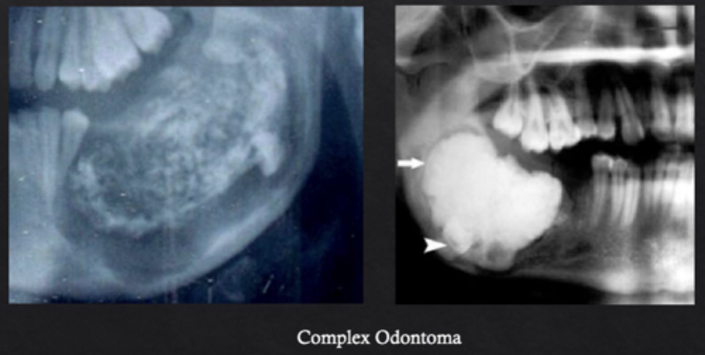 <p>Disorganized mass of dental tissues without a tooth-like form</p>
