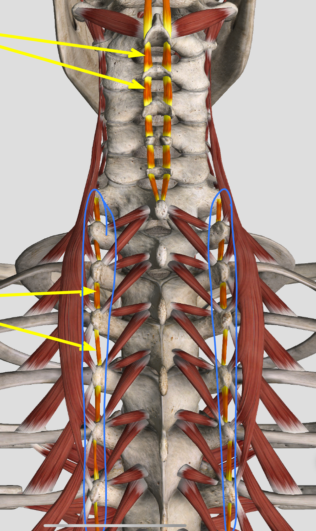 <p>What mm?</p><p>O, I, A bilateral and unilateral, N</p>