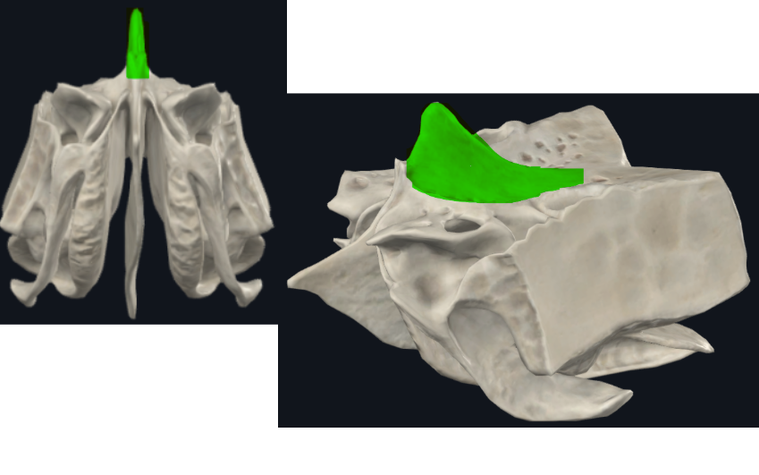 <p>Triangular, borde anterior bajo articula con el hueso frontal y completan el agujero ciego(foramen cecum) entre surcos</p>