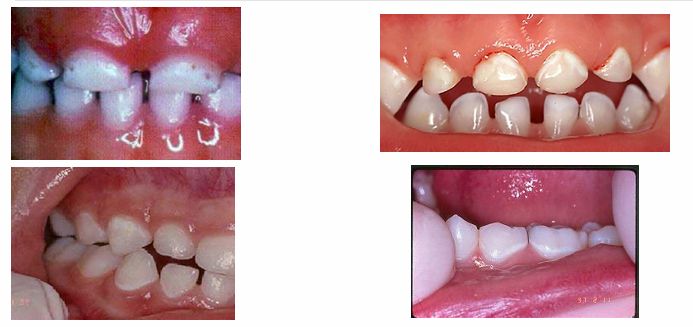 <p>-white spot lesions</p><p>-not as visible when dry → become chalky</p>