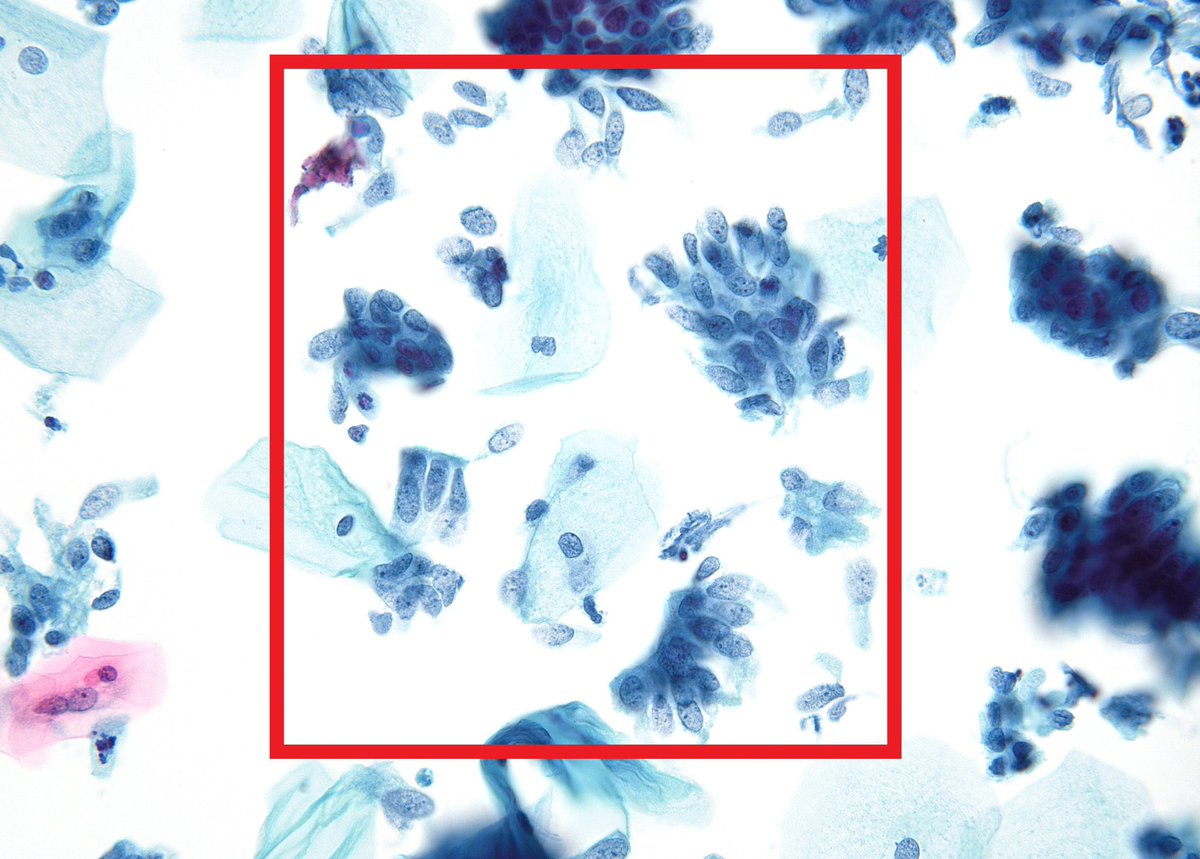 <p>Femme de 40 ans, frottis cervical </p><p>1) Diagnostic</p><p>2) Caractéristiques cliniques </p><p>3) Cytomorphologie</p><ul><li><p>Différenciation</p></li><li><p>Noyaux</p></li><li><p>Autres </p></li></ul><p>4) </p><ul><li><p>DD importants </p></li></ul><p></p>