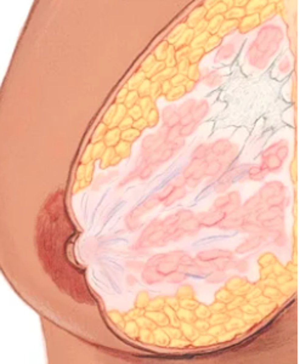 <p>Cancers that spread into surrounding breast tissue.</p><p>- May present as a solitary, unilateral, 3-dimensional, usually nontender mass.</p><p>- Solid, stony, hard, dense, and fixed to underlying tissues or skin as cancer becomes invasive.</p><p>- Borders are irregular and poorly delineated. Grows constantly. Requires diagnostic mammogram for those over age 30 years and at average risk.</p><p>- Found in those 30 to 80 years of age; increased risk across all ages until age 80 years.</p><p>- As cancer advances, signs include firm or hard irregular axillary nodes; skin dimpling; nipple retraction, elevation, and discharge.</p>