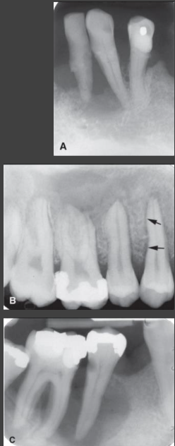 <ul><li><p><strong>Malignant neoplasms (squamous cell carcinoma)</strong></p><ul><li><p>More extensive bone destruction of localized region beyond periodontium (invasive pattern)</p></li><li><p>Irregular widening of PDL space along entire length and destruction of the lamina dura</p></li><li><p>Invasive border- poorly defined, ragged or irregular periphery</p></li></ul></li><li><p><strong>Langerhans cell histiocytosis</strong></p><ul><li><p>Often manifests as one or more regions of bone destruction around roots of teeth</p></li><li><p>Appearance of “teeth floating in space”</p></li><li><p>Epicenter of bone destruction at mid-root level rather than crest – “scooped-out” with crest less resorbed or intact</p></li></ul></li><li><p><strong>Raise suspicion of other disease if</strong></p><ul><li><p>Presence of few adjacent loose teeth when rest of mouth shows no sign of periodontal disease</p></li><li><p>Bone destruction does not have pattern/morphology of periodontal disease (apical progression)</p></li><li><p>Bone destruction has ill-defined borders and lacks a peripheral sclerotic bone response</p></li></ul></li></ul><p></p>