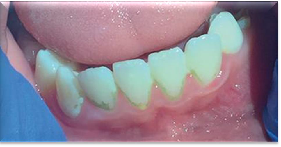 <p>What causes Green or Orange extrinsic stain?</p>