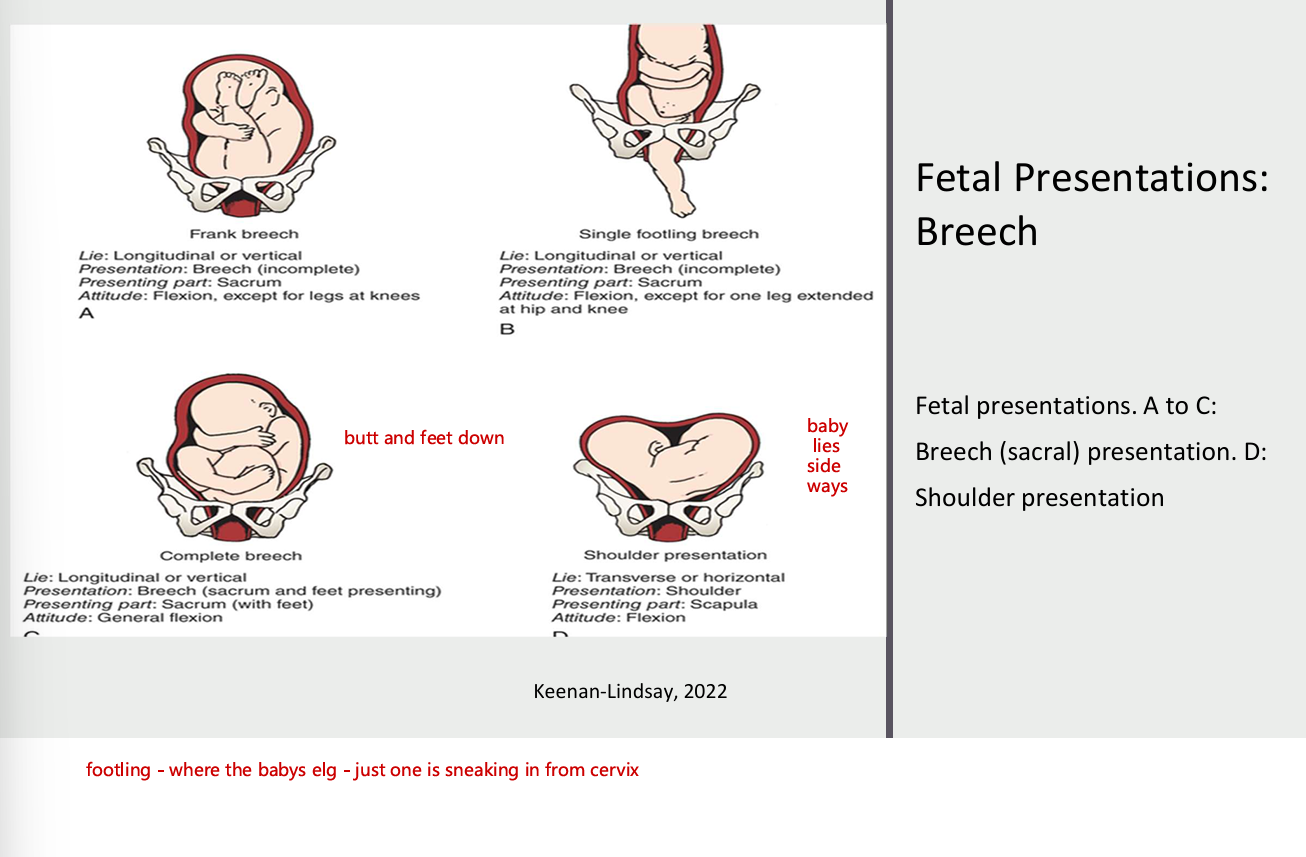 <ul><li><p>fetal presentations, A to C</p></li><li><p>breech (sacral) presentation. D: shoulder presentation</p></li></ul><p></p>