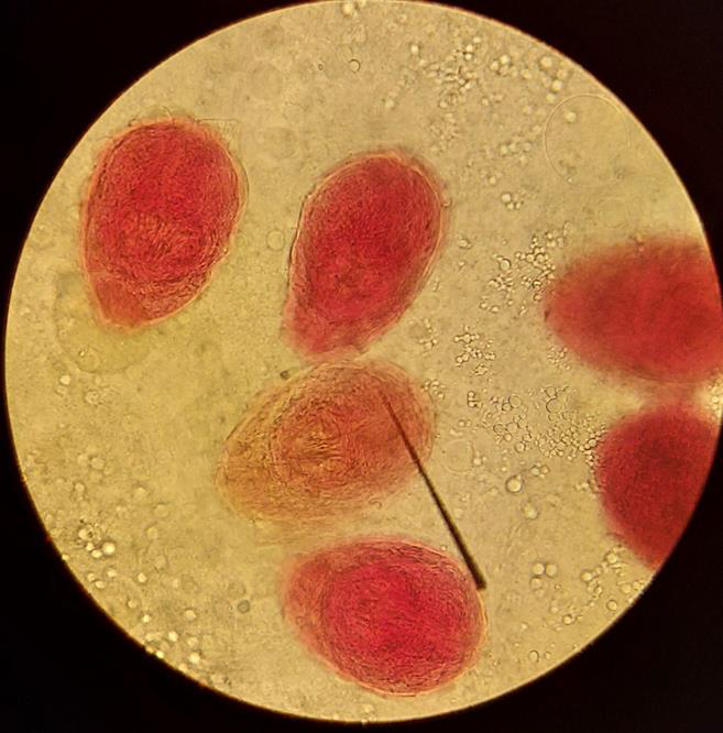 <p><strong>Identify the parasitic stage.</strong></p><p></p><p><strong>Mention the contents of this stage.</strong></p><p></p><p><strong>State the best method for diagnosing this disease.</strong></p><p></p><p></p>