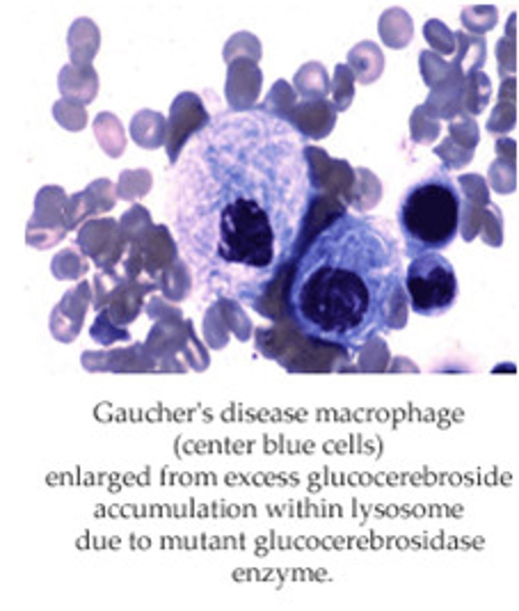 <p>Gaucher disease macrophage (glucocerebrosidase deficiency)</p><p>#1 lysosomal storage disease</p><p>Build up of glucocerbroside</p><p>"Crinkled tissue paper cells"</p>