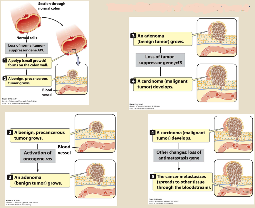 - Loss of normal tumor- suppressor gene APC
1) Polyp (Small growth) forms on colon wall
2) A benign, precancerous tumor grows
- Activation of oncogene RAS
3) An adenoma (benign tumor) grows 
- Loss of tumor-suppressor gene p53
4) A carcinoma (malignant tumor) develops 
- Other changes; loss of anti-metastasis gene
5) The cancer metastasizes (spreads to other tissue through bloodstream)