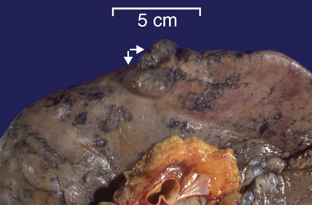 <p>Tipo de enfisema</p>
