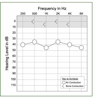 <p>normal, conductive, senso?</p>