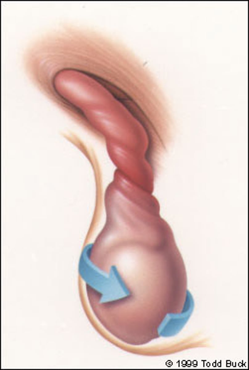 <p>twisting of the spermatic cord causing decreased blood flow to the testis, occurs most often during puberty and often presents with sudden onset of severe testicular or scrotal pain. Because of lack of blood flow to the testis, it is often considered a surgical emergency</p>
