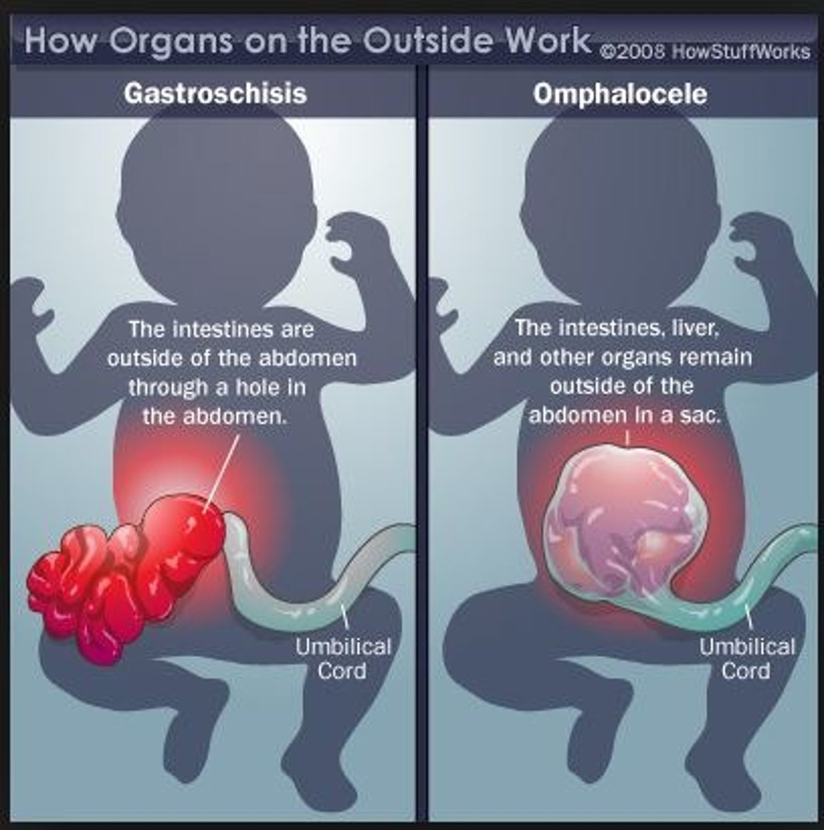 <p>Gastroschisis</p><p>-abdominal contents coming from right of umbilicus</p><p>-abdominal contents NOT covered by a sac</p><p>-happens more commonly with prematurity</p><p>-not associated with congenital abnormalities</p><p>Ompahlocele</p><p>-abdominal contents coming from midline defect</p><p>-abdominal contents covered by sac</p><p>-associated with congenital abnormalities</p>