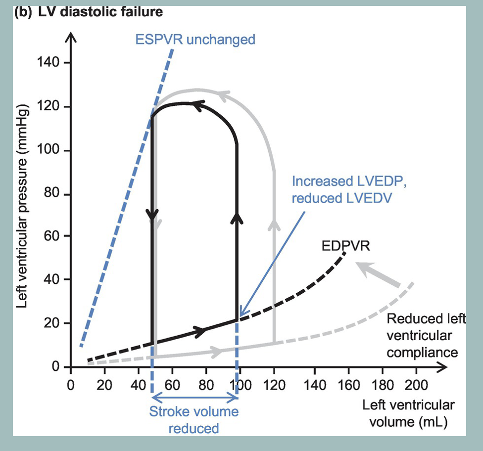 <ul><li><p><span>there is a reduction in ventricular compliance which increases the slope of the EDPVR. This shifts the pressure volume loop to the left (black loop). The result is a decrease in end-diastolic volume (less ventricular filling) and an increase in end-diastolic pressure. Stroke volume decreases and stroke work also decreases.</span></p></li></ul><p></p>