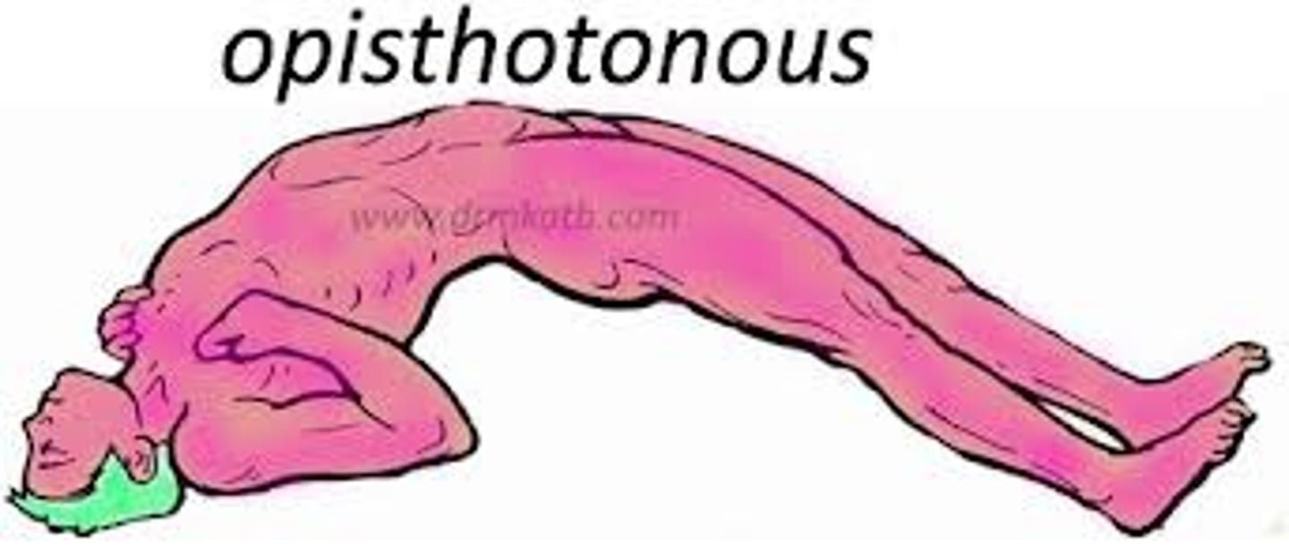 <p>Abnormal posture seen in severe tetanus --&gt; the back becomes extremely arched due to muscle spasms</p>