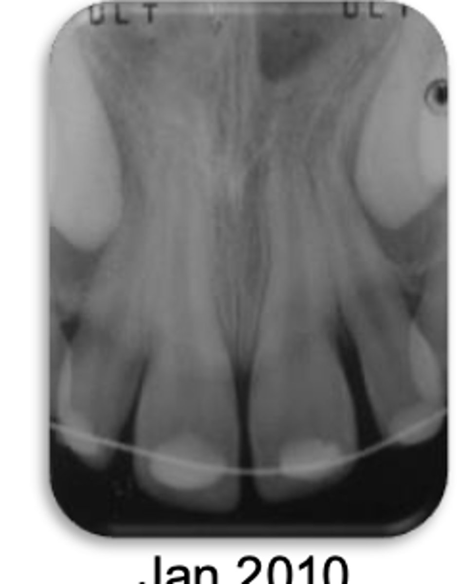 <p>Patient presents with these radiographic findings. What is the most likely diagnosis? </p><p>- Absence of lamina dura/PDL around lesion.</p><p>- Bone trabeculation occupying previous root surface.</p>
