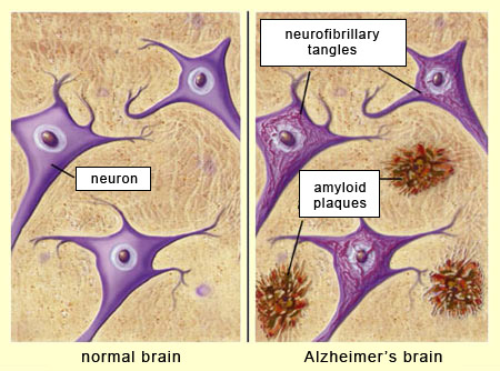<p>How do amyloid plaques form?</p>