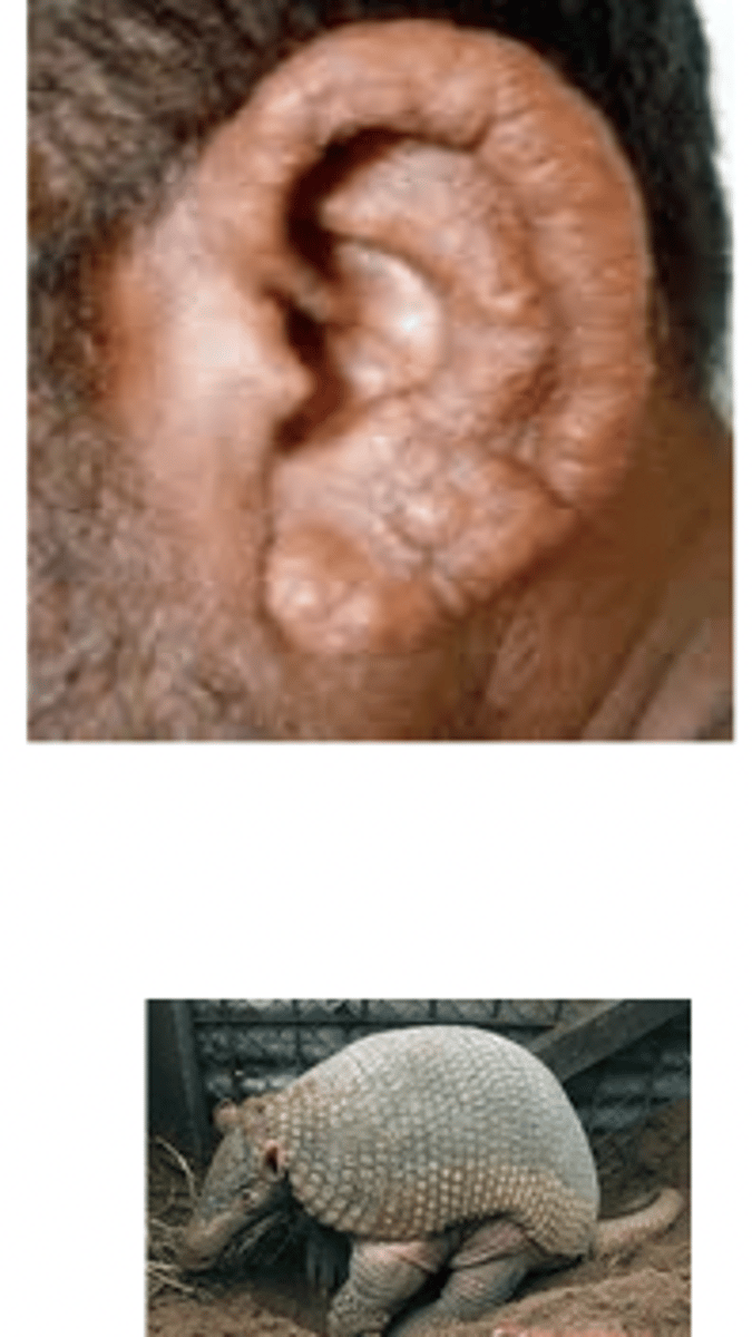 <p>Multiple papules and nodules dt chronic infection</p>