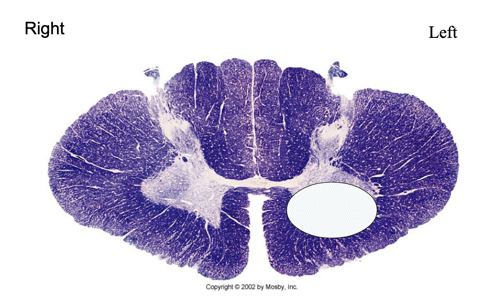 <p>What is lesioned here? What clinical findings would you expect with this lesion?</p>