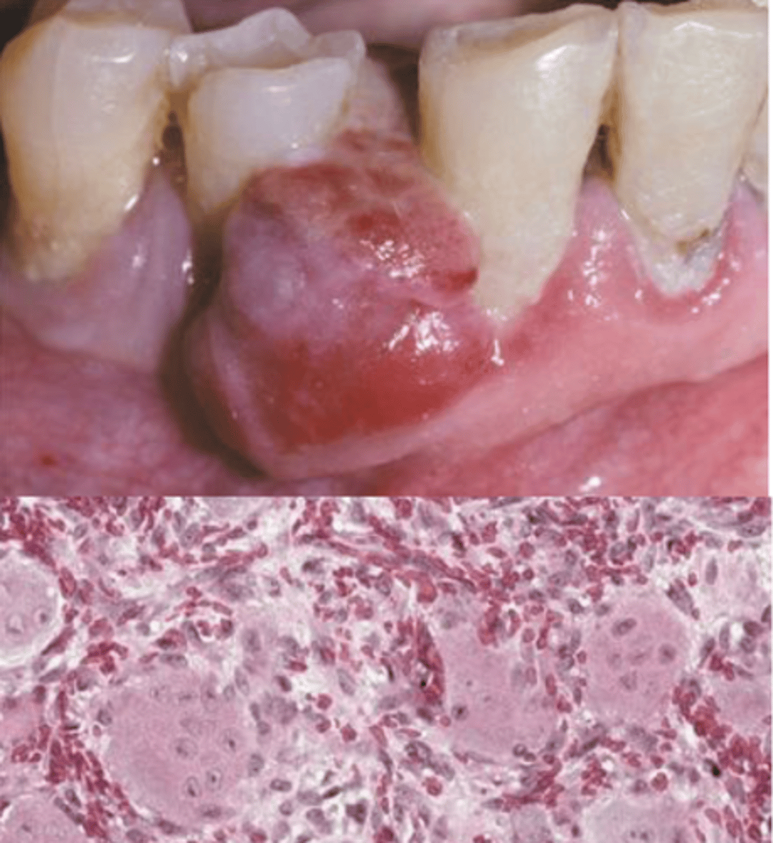 <p>___ ____ ___ granuloma's are common and reactive lesions caused by local irritation or trauma. Its clinical features are that it occurs exclusively on the gingiva or edentulous alveolar ridge, a red or red-blue nodular mass (frequently ulcerated), "cupping" resorption of the underlying alveolar bone may be noted. Local surgical excision down to the underlying bone with submission of the substance for histopathologic examination, adjacent teeth should be carefully scaled</p>