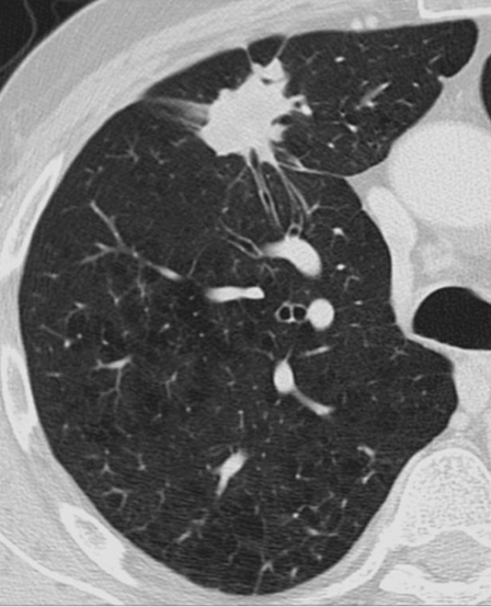 <p>benign or malignant?</p>