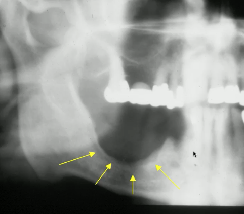 <p>what would smooth borders of malignant lesion indicate?</p>