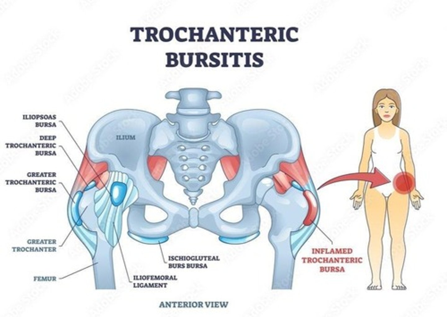 <p>Inflammation of the bursa near the hip.</p>