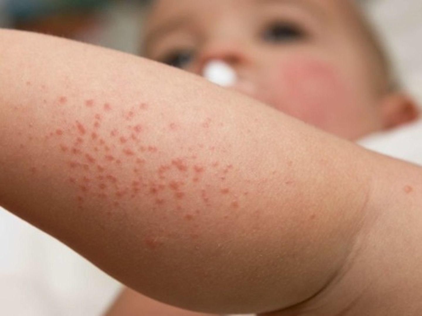 <p>rash, spots</p>