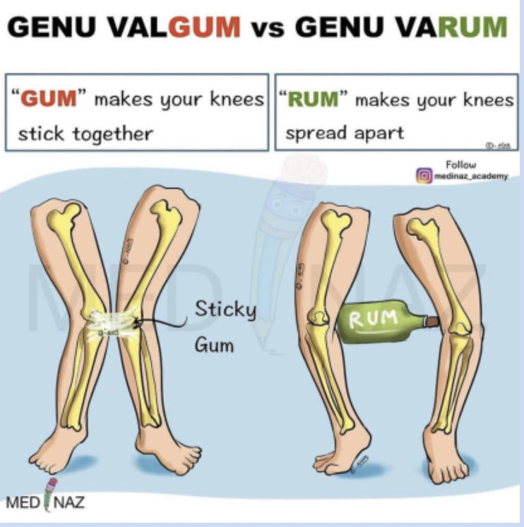 <p>Tibia is not aligned with femur in straight line- can create imbalance of forces between femur and tibia</p><p>varum- bow leg</p><p>valgum- knock knee</p>