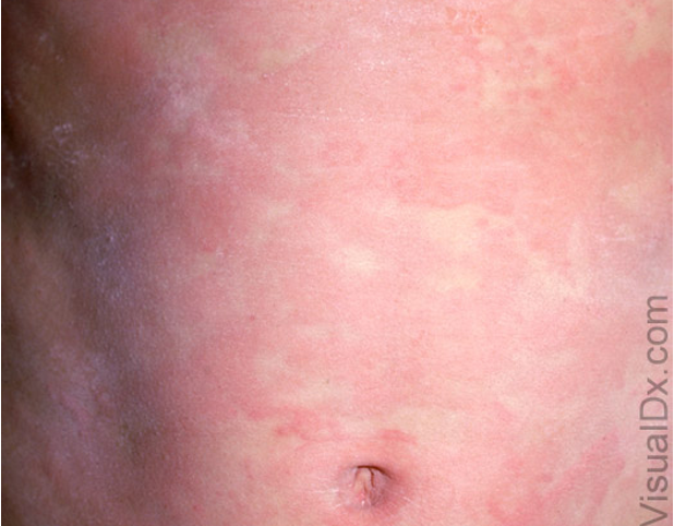 <ul><li><p>transient pruritic edematous papules and plaques</p></li><li><p>superficial and well defined</p></li><li><p>can be assoc. w/ angioedema</p></li><li><p>location: face, lips, trunk, extremities</p></li><li><p><u>acute:</u> &lt; 6 wks, IgE dependent</p></li><li><p><u>chronic:</u> &gt; 6 wks</p></li></ul><p></p>