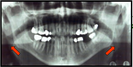 <ul><li><p><span>is an outline of the pharnx.​</span></p></li><li><p><span>appears as a vertical radiolucent band superimposed over the ramus of the mandible.</span></p></li></ul><p></p>